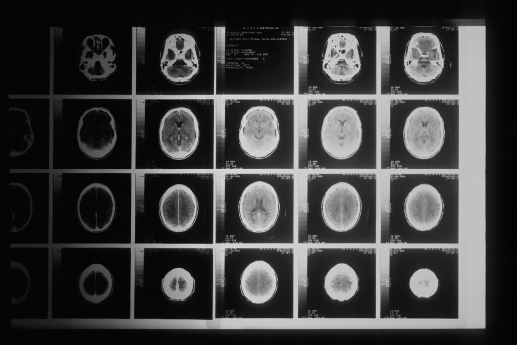 Medical imaging scans used to diagnose brain cancer.